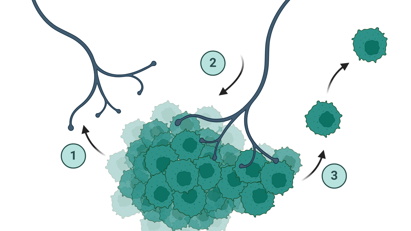 An illustration of a tumor recruiting a nearby nerve and how that action helps cancer cells leave the tumor.