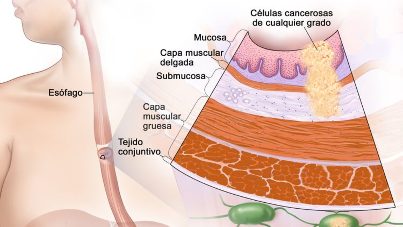 Ilustración anatómica del cáncer de esófago en estadio 2b, con un primer plano de ganglios linfáticos cercanos donde hay cáncer.