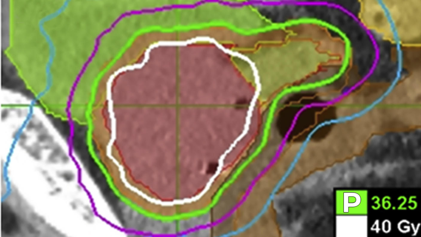 An imaging scan of the prostate and surrounding area depicting an SBRT treatment plan.