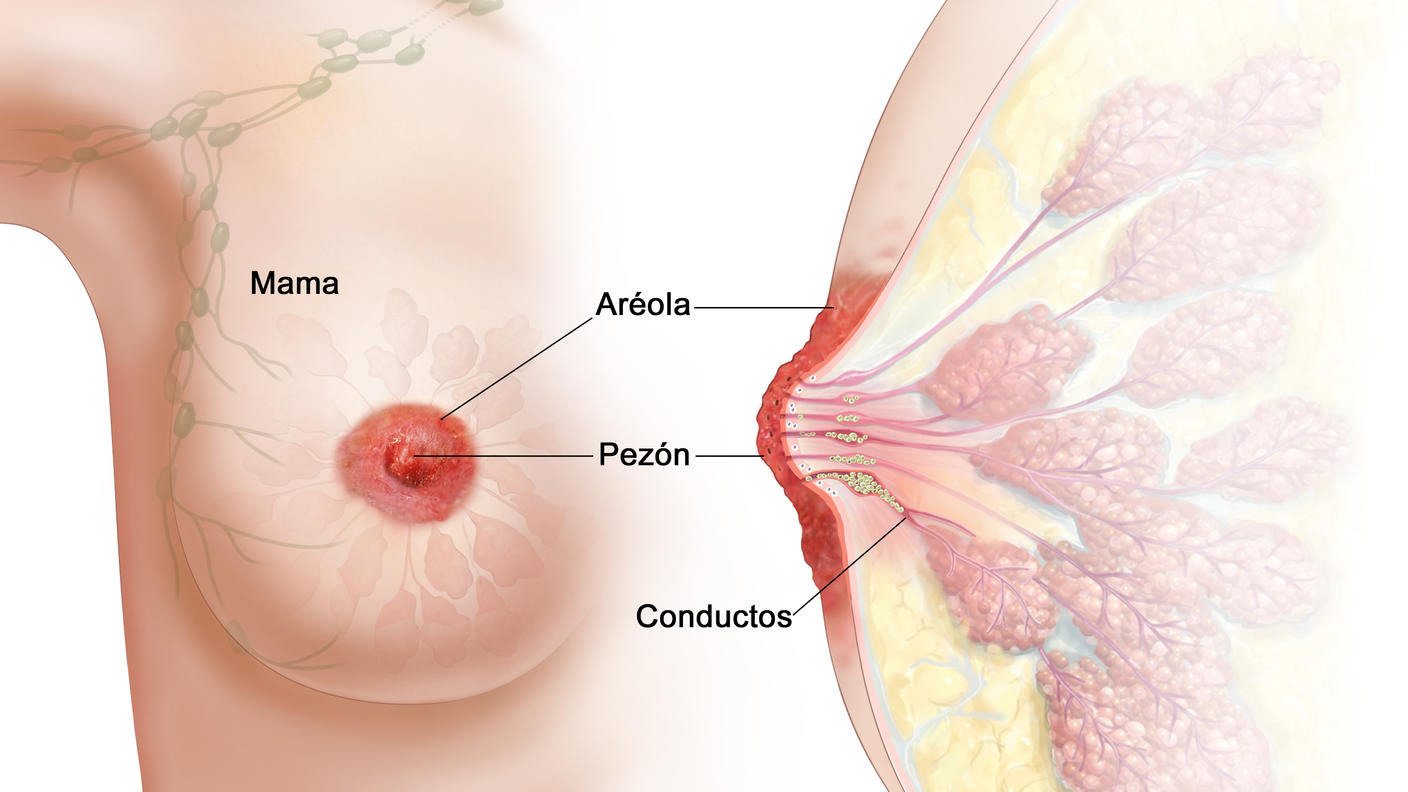 Enfermedad de Paget de la mama. En el dibujo se muestra una vista frontal de la mama donde el pezón y la aréola están enrojecidos y con costras. También se muestra una vista lateral de la mama con células cancerosas en los conductos mamarios.