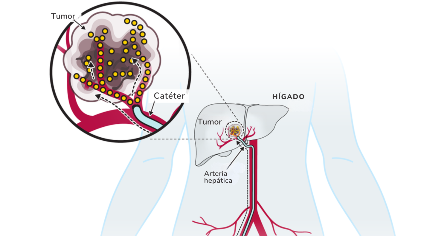 Ilustración de una terapia en la que se infunde un medicamento por una arteria para que fluya hasta el tumor en el cáncer del hígado.