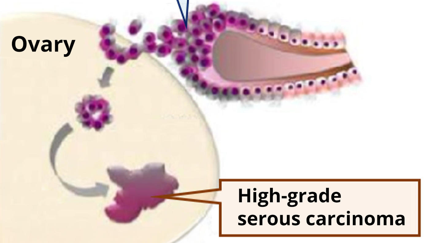 An illustration of STIC lesions (small purple bubbles) in the fallopian tubes, with several then traveling to an ovary, and finally forming a tumor in the ovary.