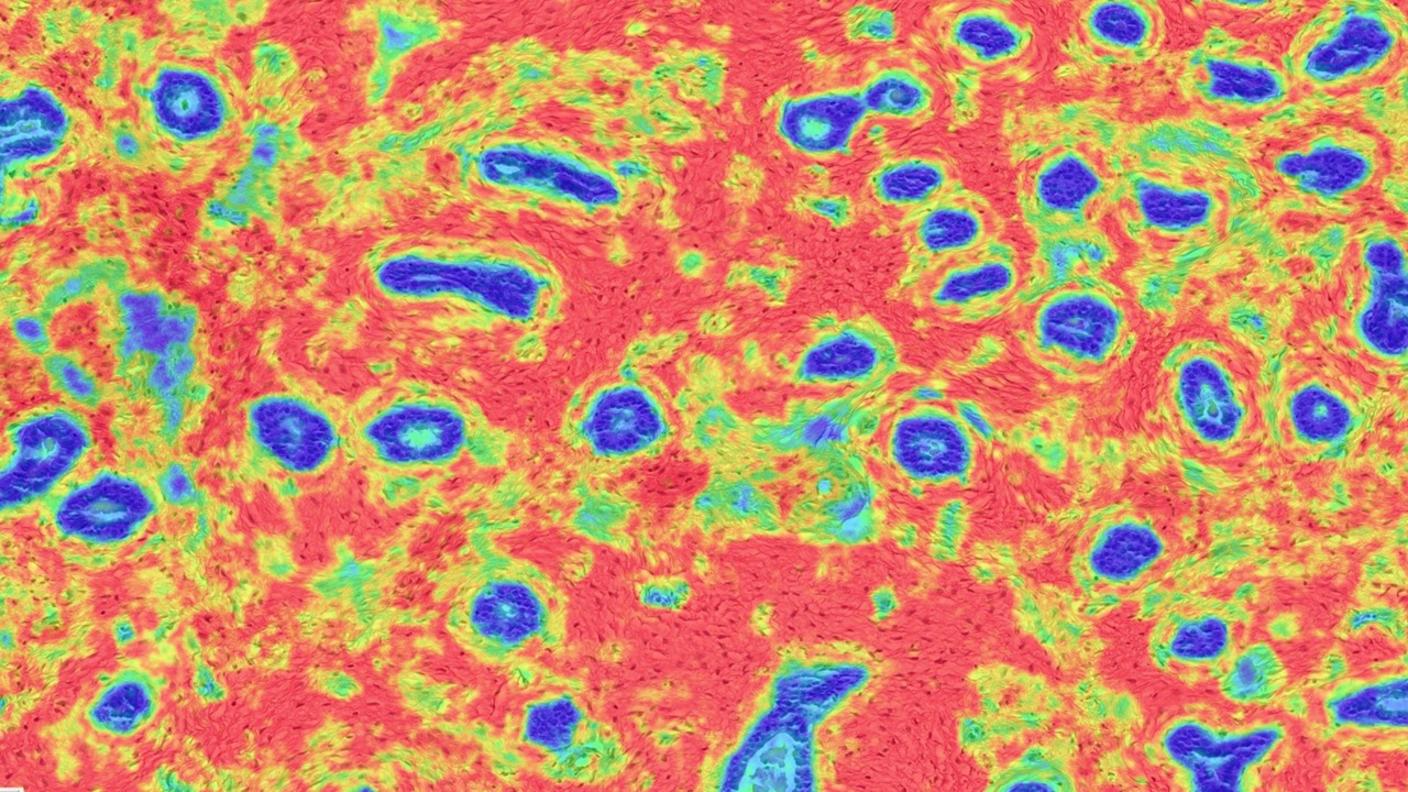 Breast tissue showing substantial changes. 