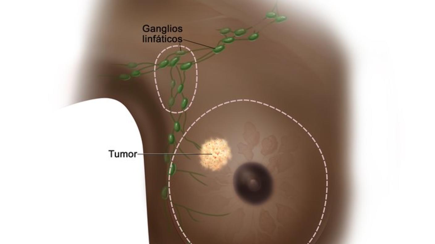 Mastectomía total (simple). En el dibujo se señalan con líneas punteadas las zonas que se extirparán: la mama completa que incluye un tumor y algunos de los ganglios linfáticos de la axila.