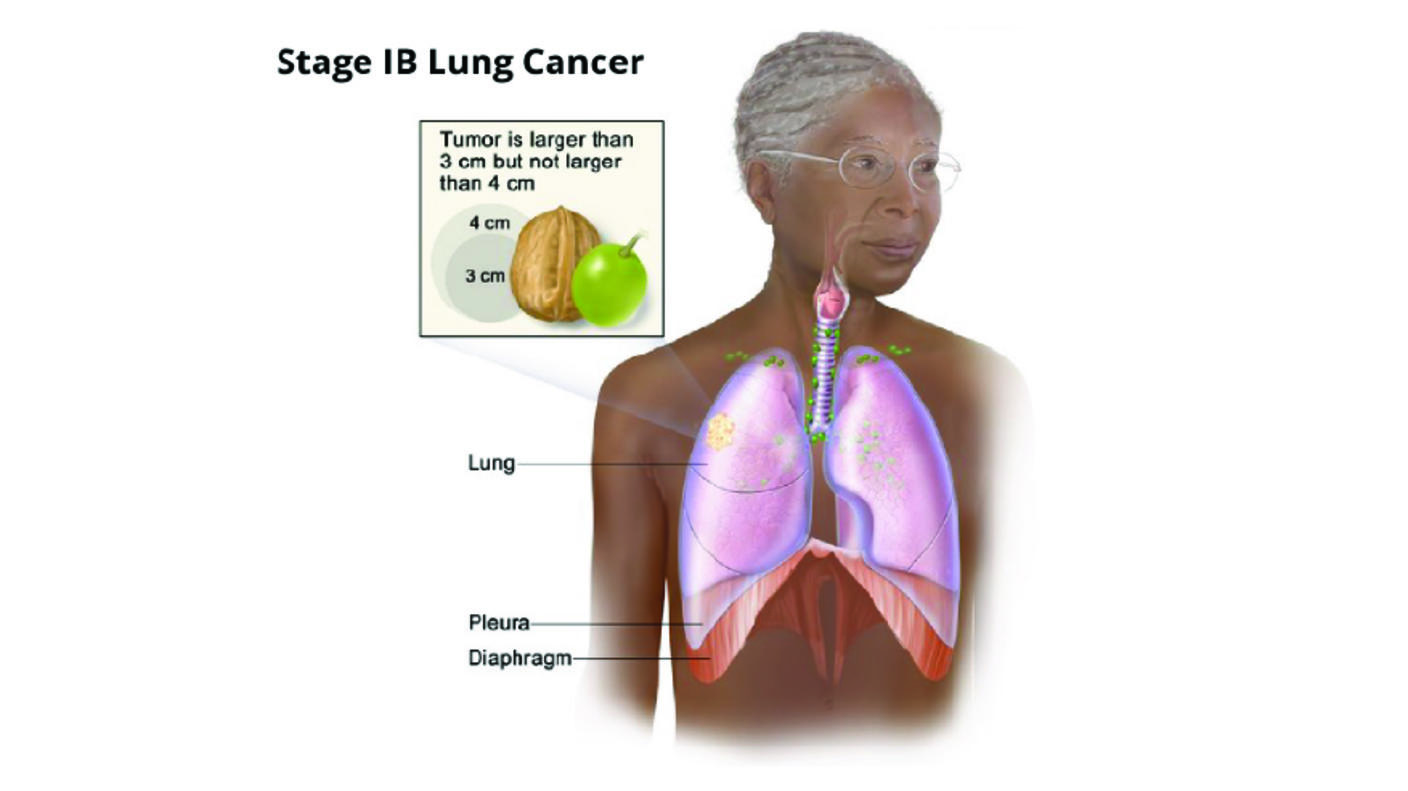 An illustration of stage 1B lung cancer
