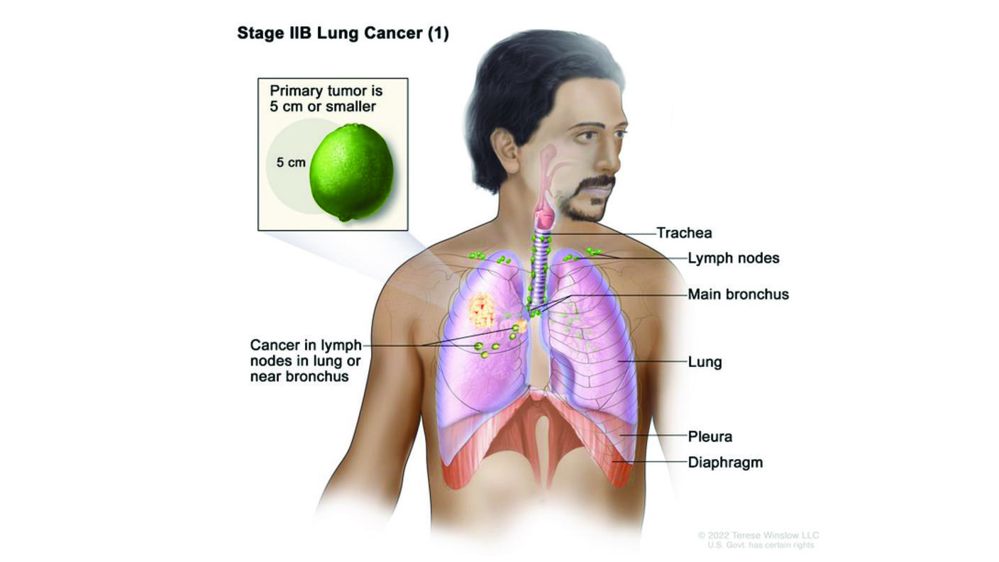 An anatomic illustration of stage 2b nonsmall cell lung cancer