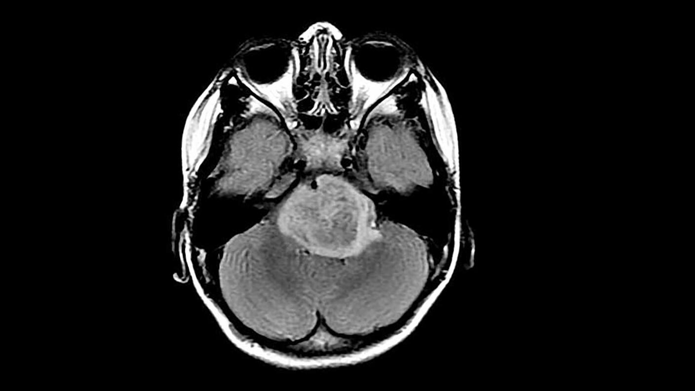 Axial brain MRI showing a large brain tumor in the posterior part of the brain.
