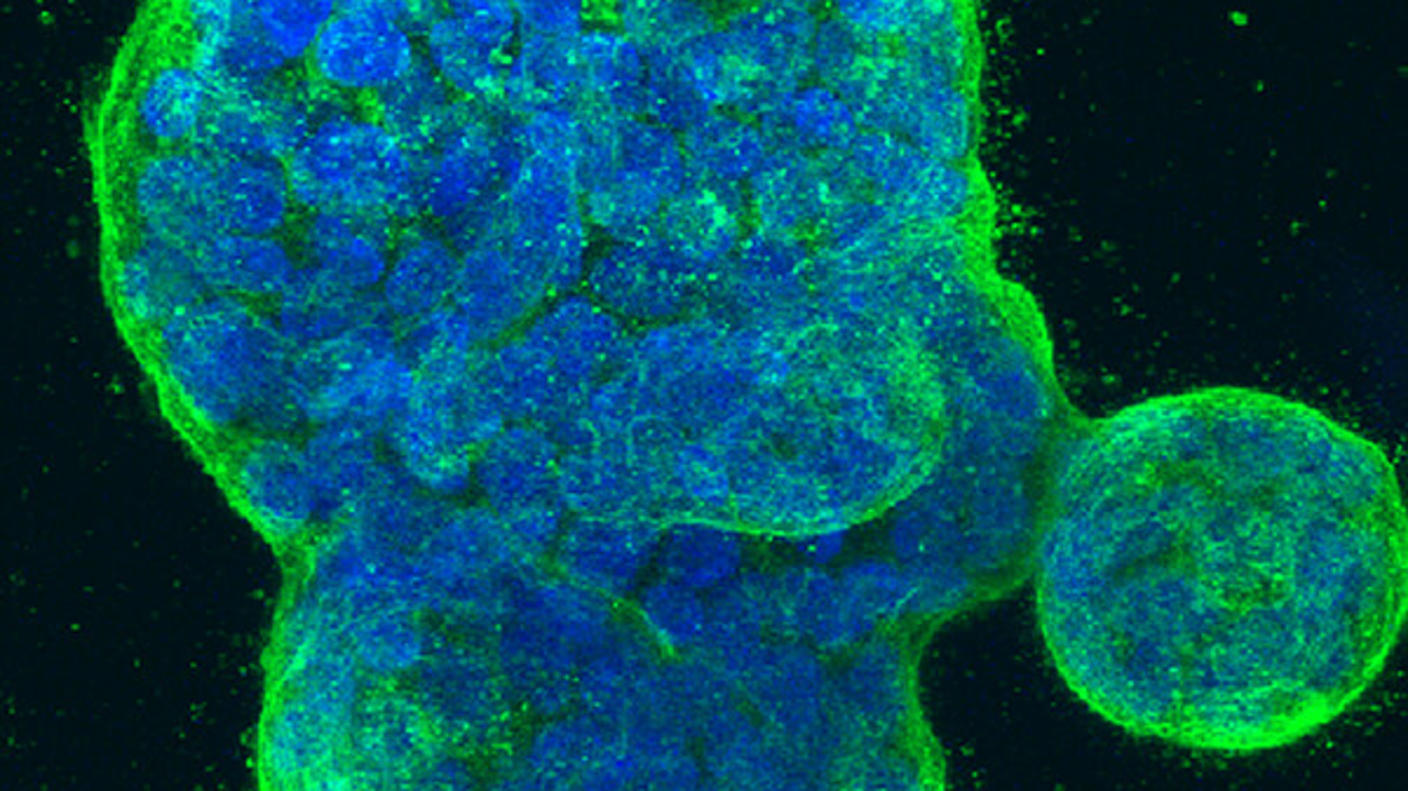 Three-dimensional culture of human breast cancer cells, with DNA stained blue and a protein in the cell surface membrane stained green. 