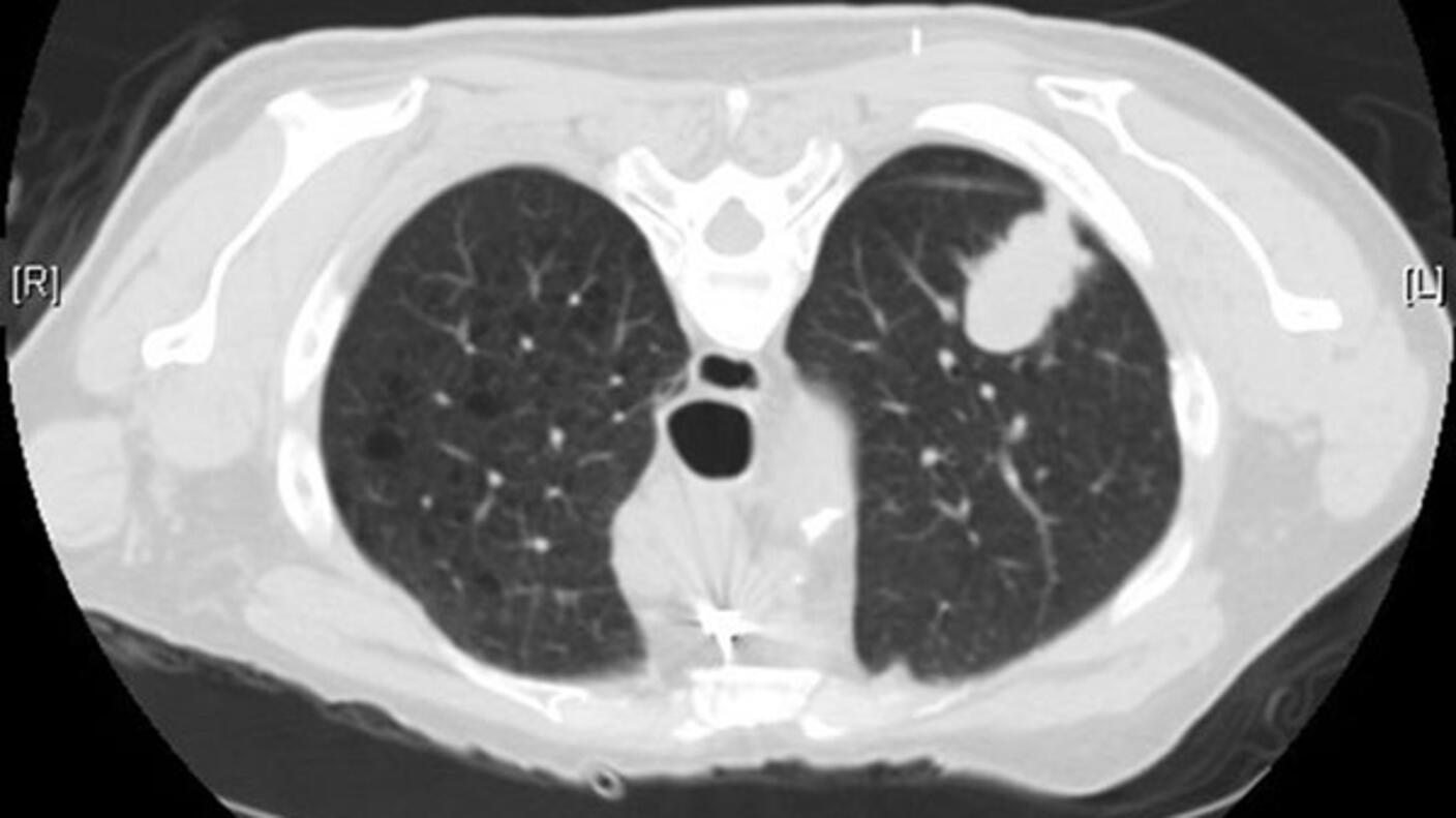 CT scan showing a cross-section of the chest with a large white mass in the left lung, indicating a tumor.