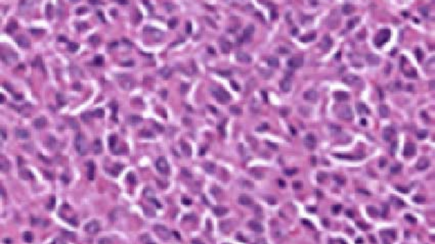 Microscopic image showing SDHC epimutant GIST (gastrointestinal stromal tumor) with epithelioid morphology, displaying pink-purple stained cells with characteristic round to oval nuclei.