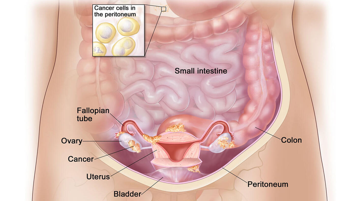 Illustration titled “Stage IIIA Ovarian Cancer” which focuses on the stomach, labeling the small intestine, colon, peritoneum, bladder, uterus, ovary, and fallopian tube. Cancer is also labeled and is present on the ovary, fallopian tube, bladder, and colon. A small inset box towards the top reads “Cancer cells in the peritoneum” showing a few yellow cancer cells. 