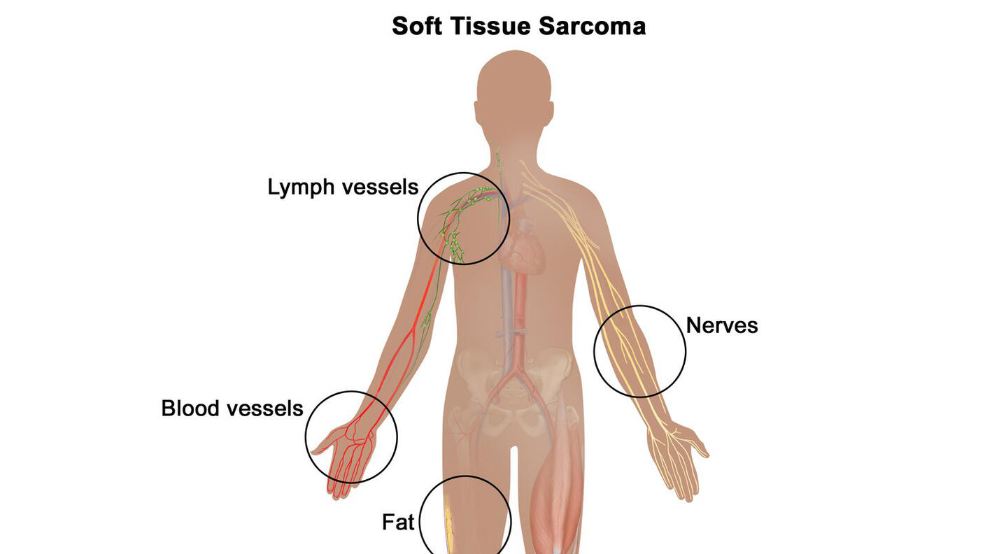 An illustration of the human body titled “Soft Tissue Sarcoma.” The body is in silhouette and has labels for various parts of the human body which are illustrated to mimic the look of each part. The labels read “Nerves”, “Muscle, Tendons, Ligaments and Cartilage”, “Fat”, “Blood Vessels”, and “Lymph Vessels.”