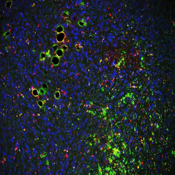 A microscopic view of breast cancer cells